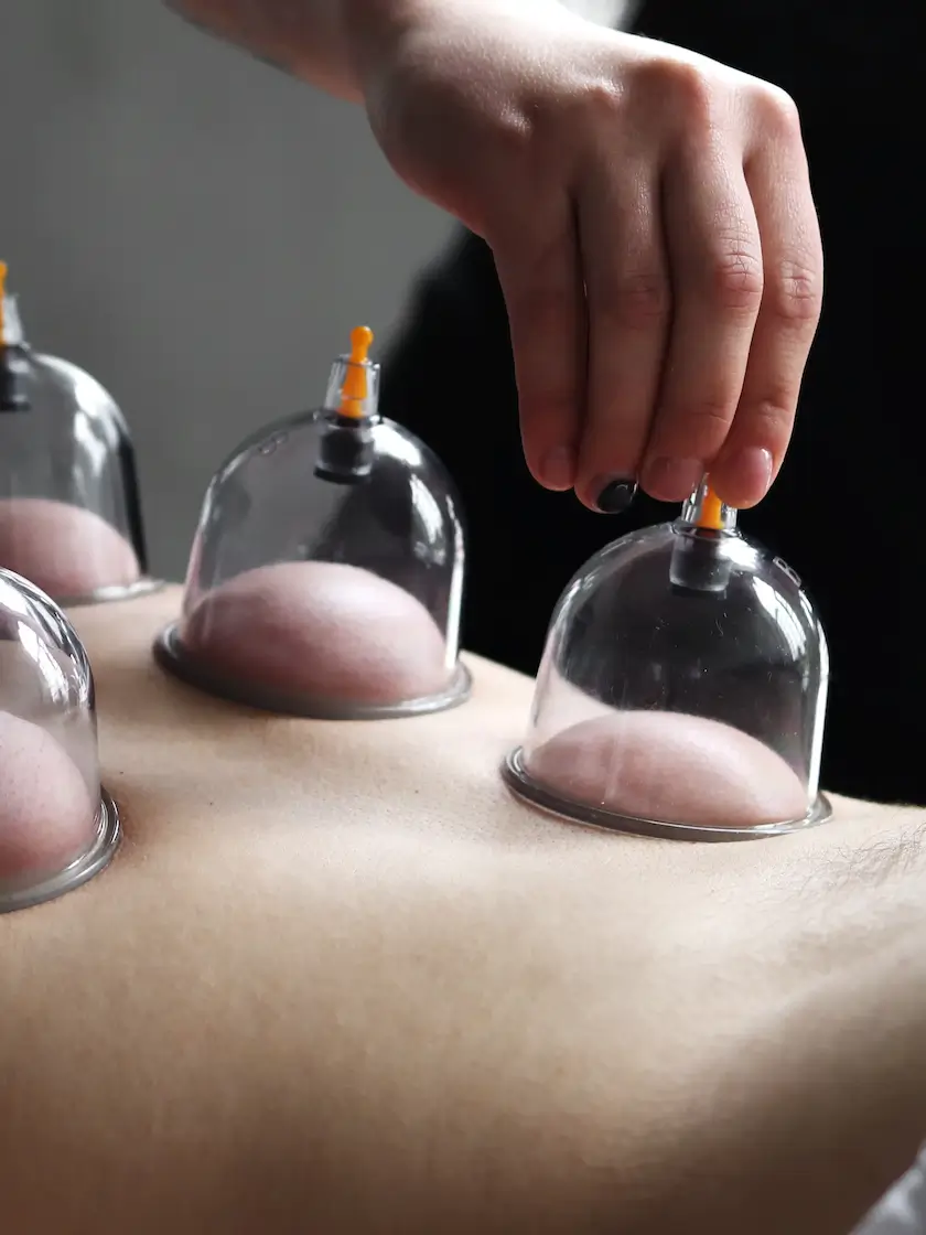 Cupping therapy